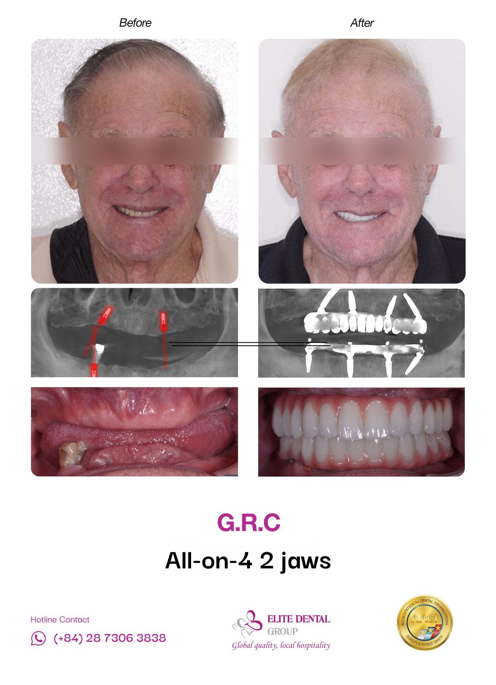 Before and after All-on-4