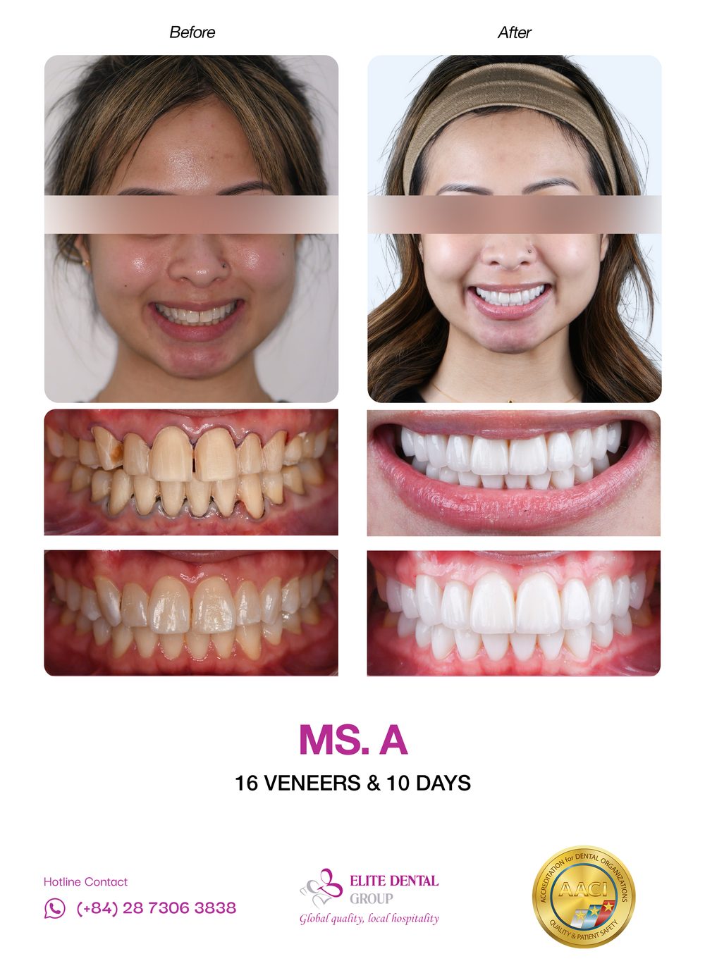 Before and after veneers case 1