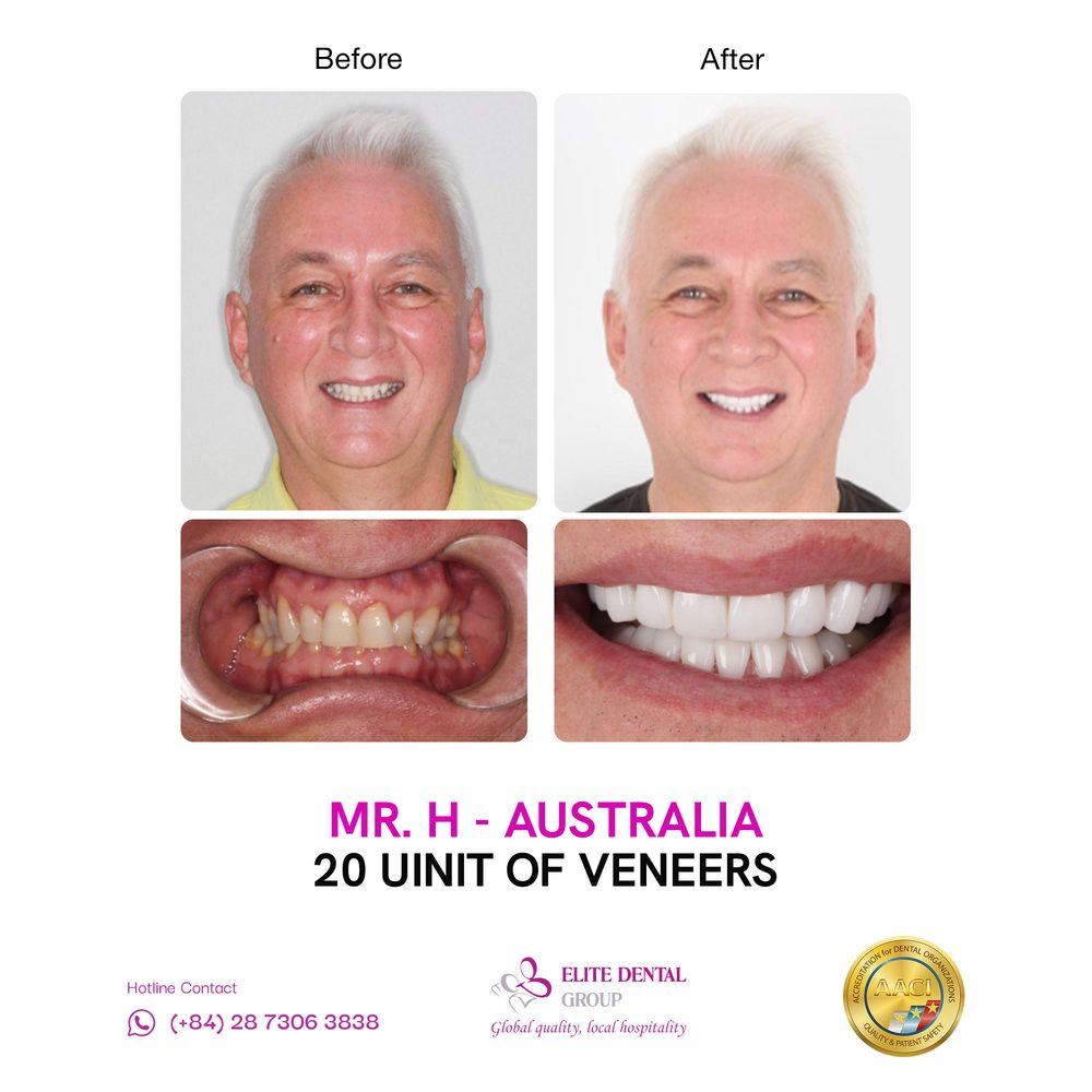 Before and after veneers case 2